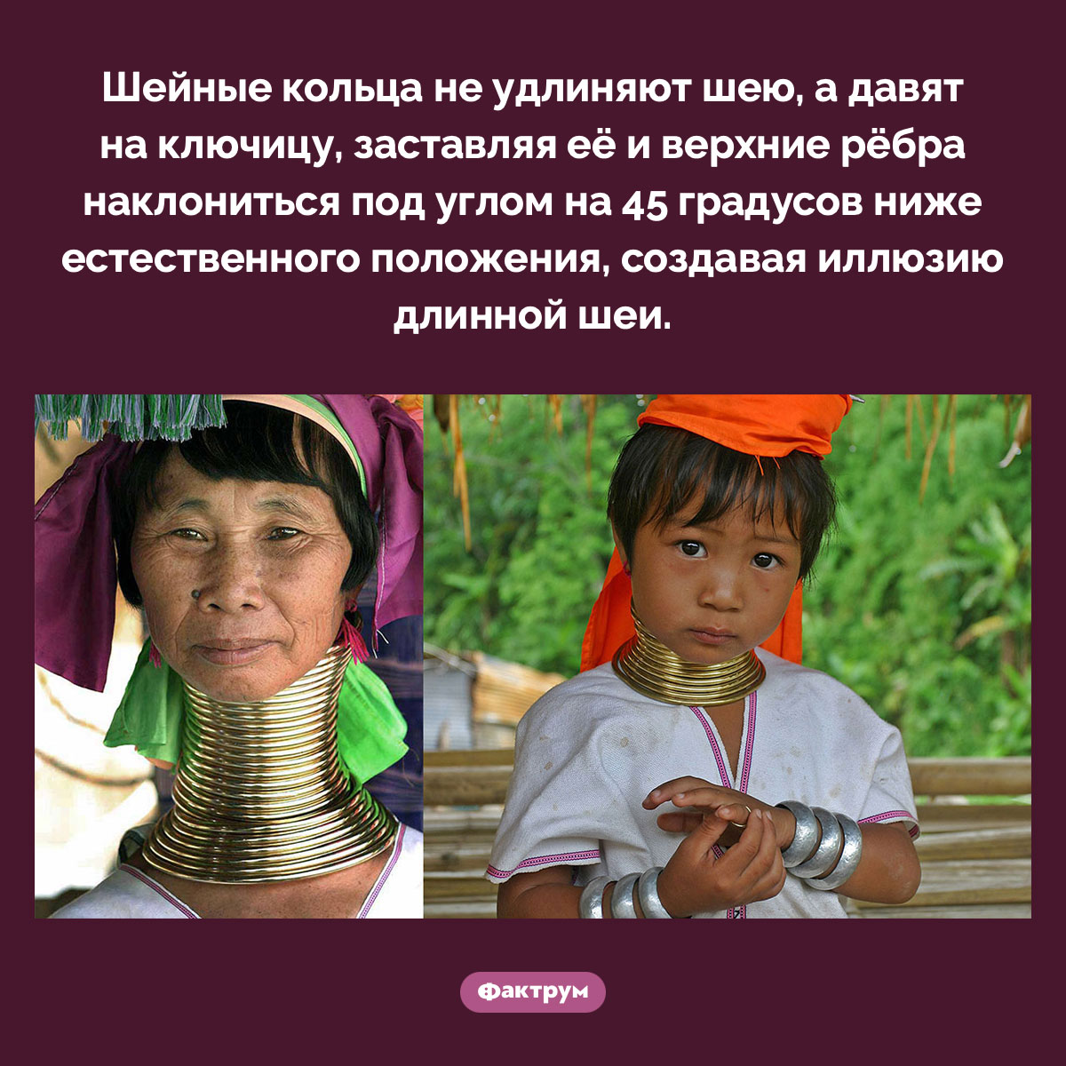 Шейные кольца не удлиняют шею, а оттягивают ключицу - похожая новость на Toplenta