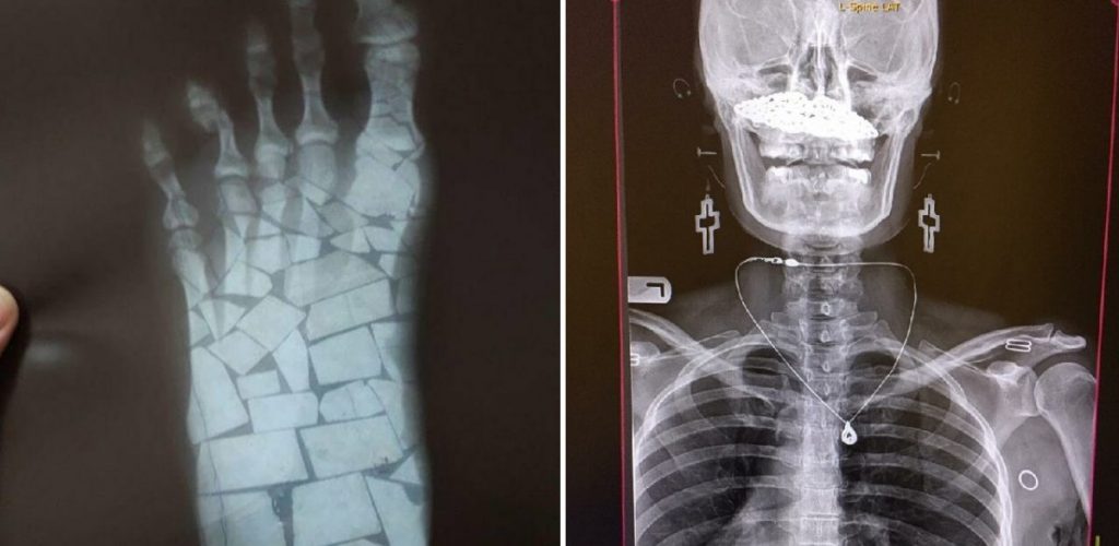 Богатый внутренний мир — 17 рентгеновских снимков, которые врачи не сразу развидят - свежие новости на Toplenta по теме Наук