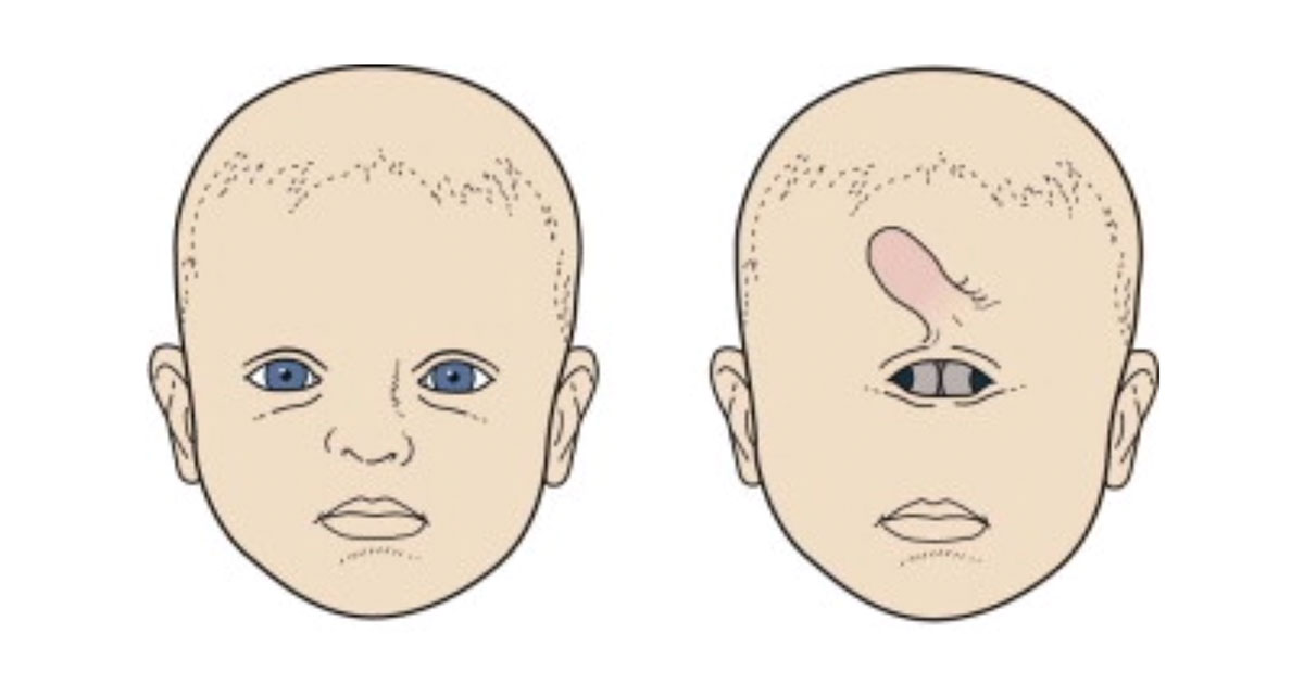 Что такое «циклопия» - свежие новости на Toplenta по теме Чел