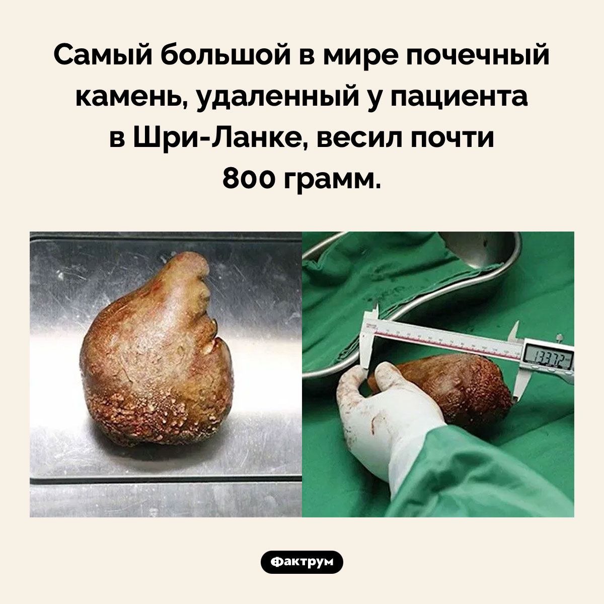 Самый большой в мире почечный камень - свежие новости на Toplenta по теме Факты в картинках