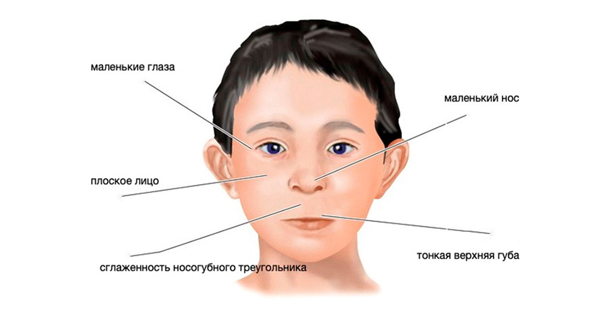 Что такое фетальный алкогольный синдром - свежие новости на Toplenta по теме СИН