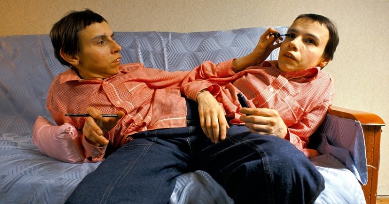 Трагическая история жизни и смерти сестер Кривошляповых — первых в СССР сиамских близнецов - свежие новости на Toplenta по теме го
