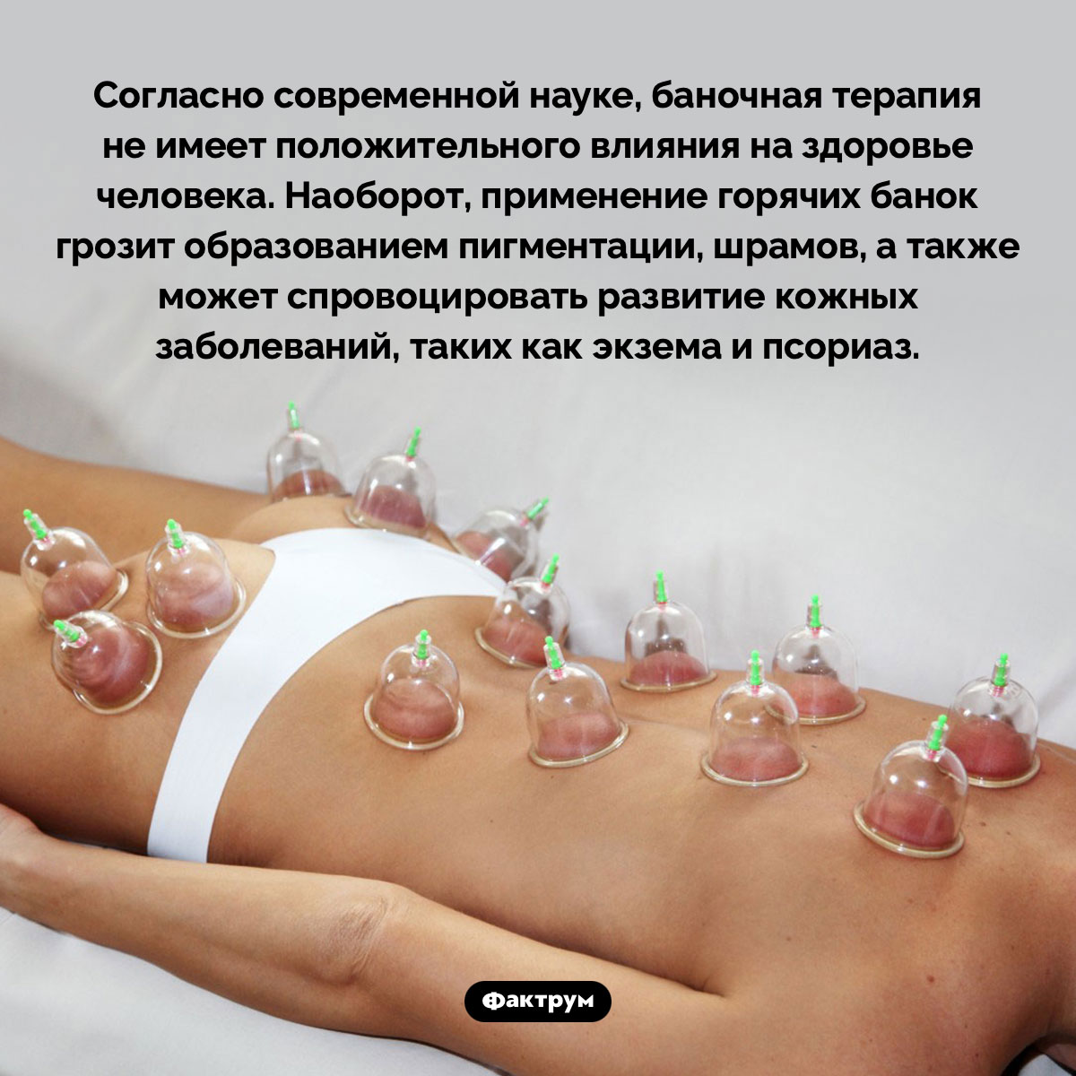 Баночная терапия вредна для здоровья - свежие новости на Toplenta по теме Факты в картинках