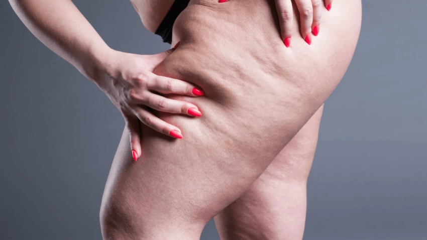 Что такое липидема, или Почему худеет все тело, кроме ног - свежие новости на Toplenta по теме здоровье и медицина