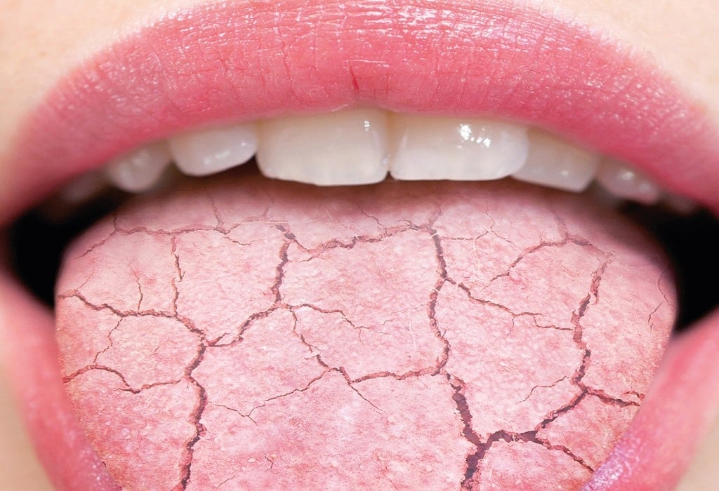 Откуда на языке трещинки и насколько это опасно? - свежие новости на Toplenta по теме чистка